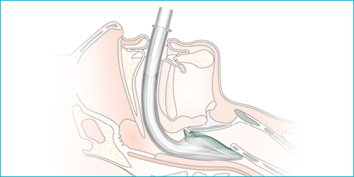 i-gel O2 Resus Pack
